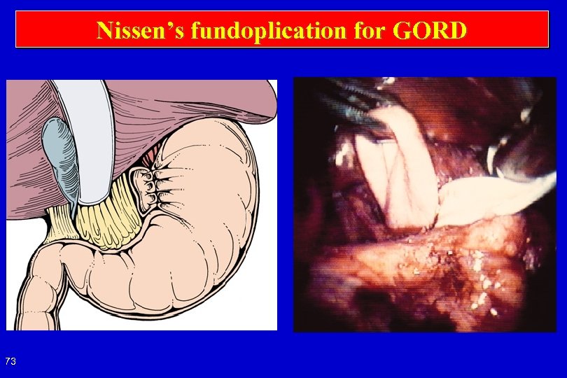 Nissen’s fundoplication for GORD 73 