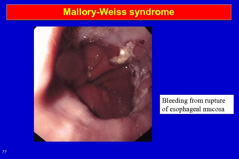 Mallory-Weiss syndrome Bleeding from rupture of esophageal mucosa 77 