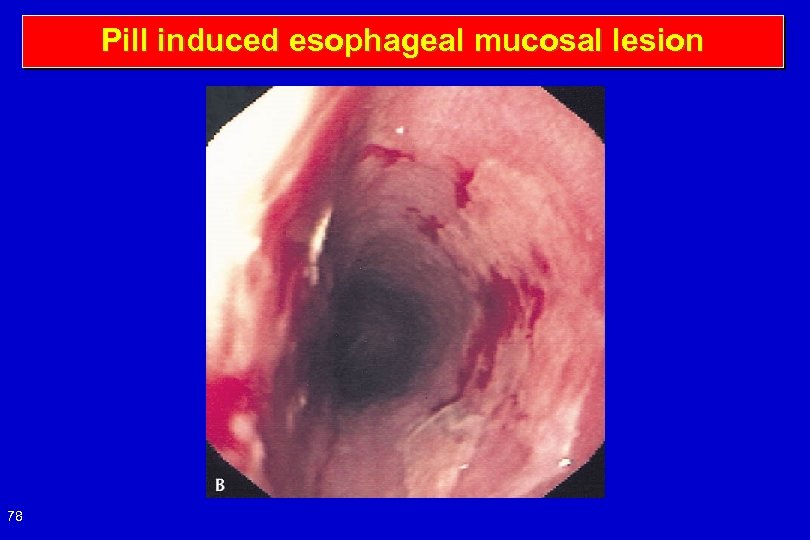 Pill induced esophageal mucosal lesion 78 