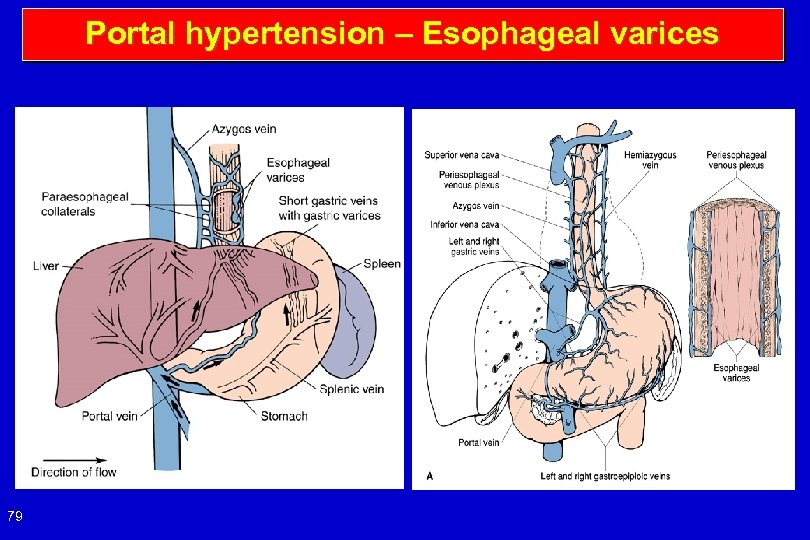 Portal hypertension – Esophageal varices 79 