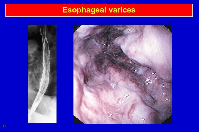 Esophageal varices 80 