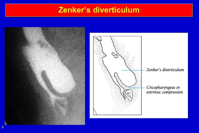 Zenker’s diverticulum 9 