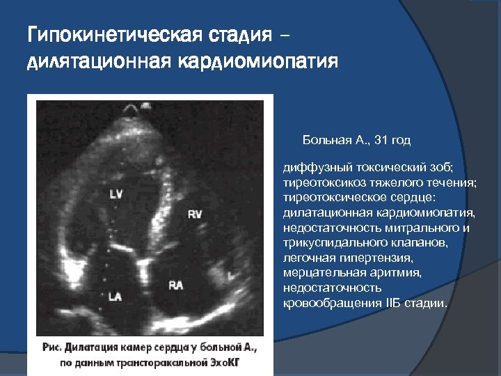 Гипокинетическая стадия – дилятационная кардиомиопатия Больная А. , 31 год диффузный токсический зоб; тиреотоксикоз