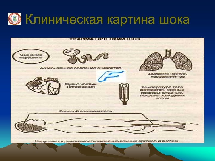 Клиническая картина шока 