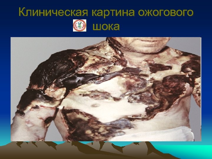 Клиническая картина ожогового шока 