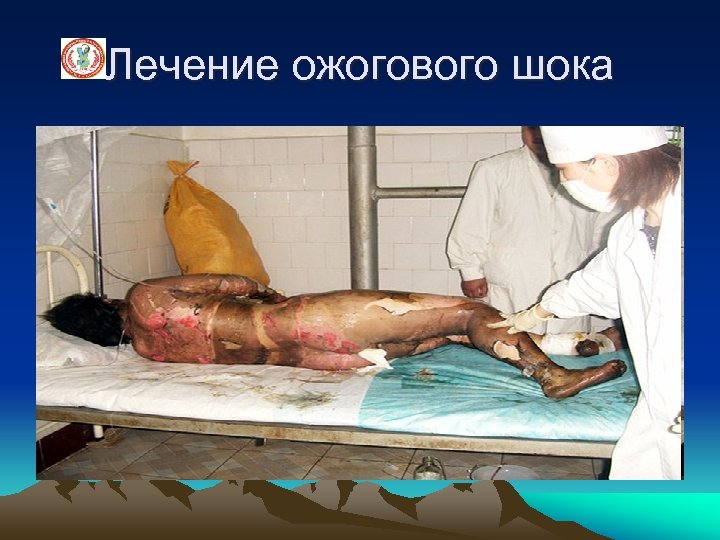 Лечение ожогового шока 