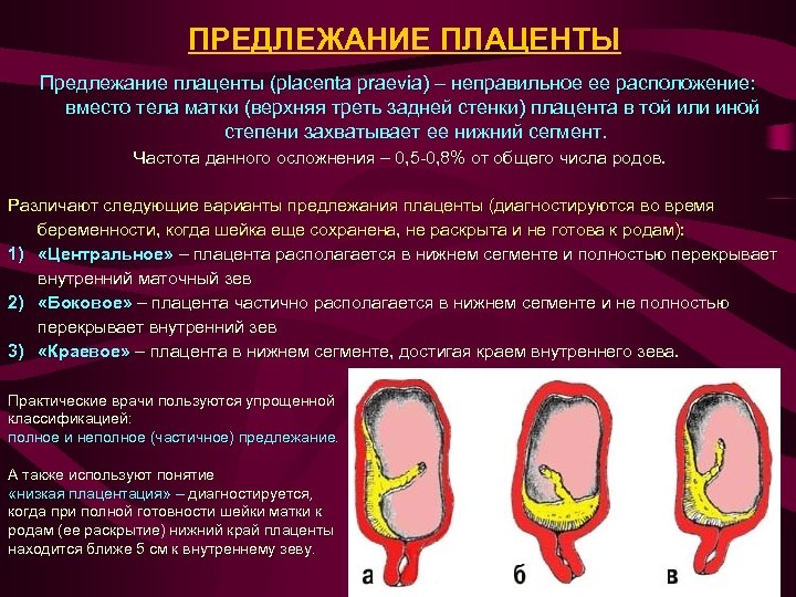 ПРЕДЛЕЖАНИЕ ПЛАЦЕНТЫ Предлежание плаценты (placenta praevia) – неправильное ее расположение: вместо тела матки (верхняя