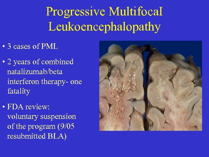 Progressive Multifoca. I Leukoencephalopathy • 3 cases of PML • 2 years of combined