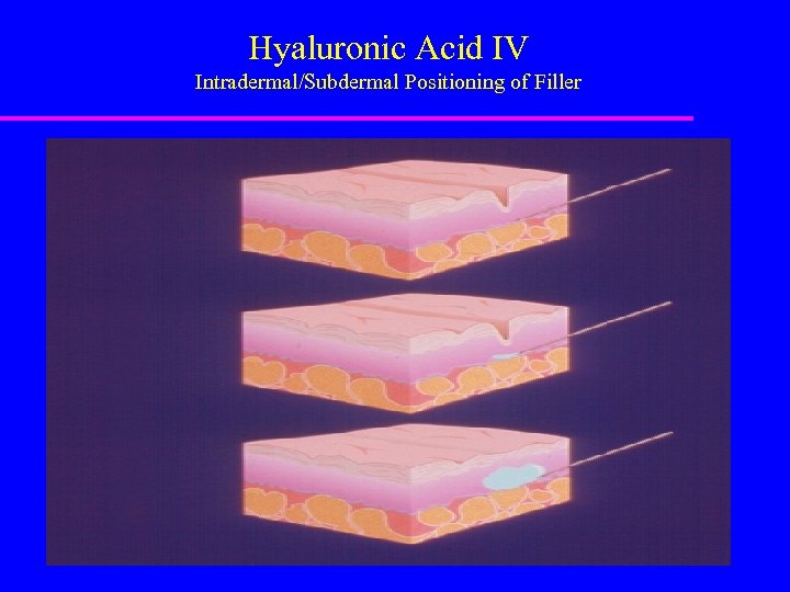 Hyaluronic Acid IV Intradermal/Subdermal Positioning of Filler 