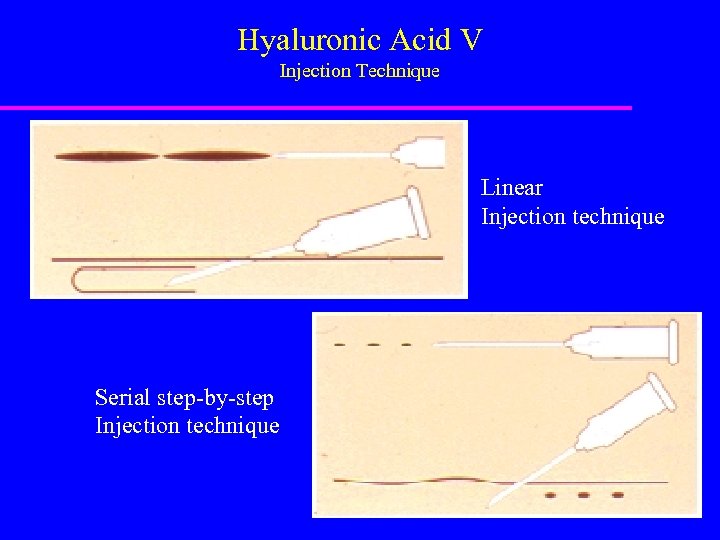 Hyaluronic Acid V Injection Technique Linear Injection technique Serial step-by-step Injection technique 
