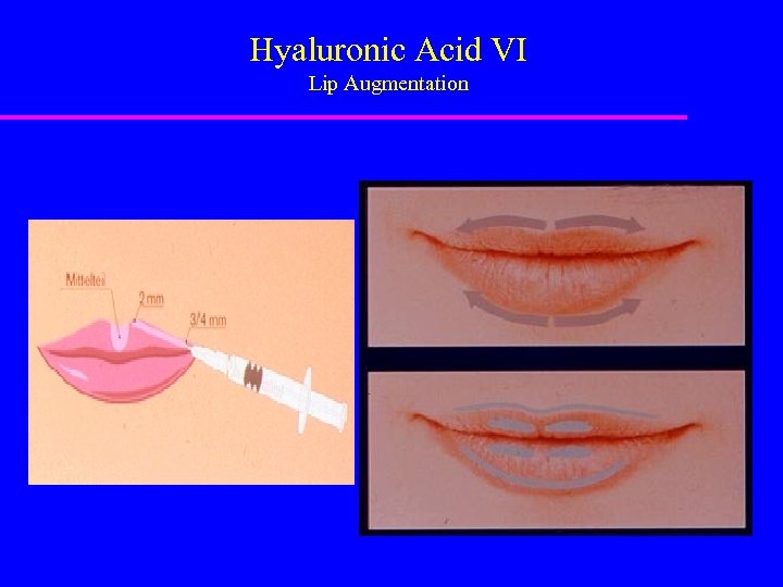 Hyaluronic Acid VI Lip Augmentation 