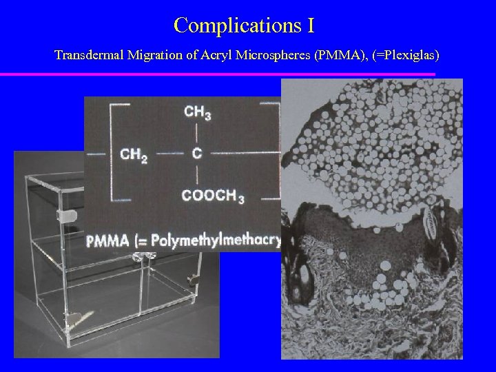 Complications I Transdermal Migration of Acryl Microspheres (PMMA), (=Plexiglas) 