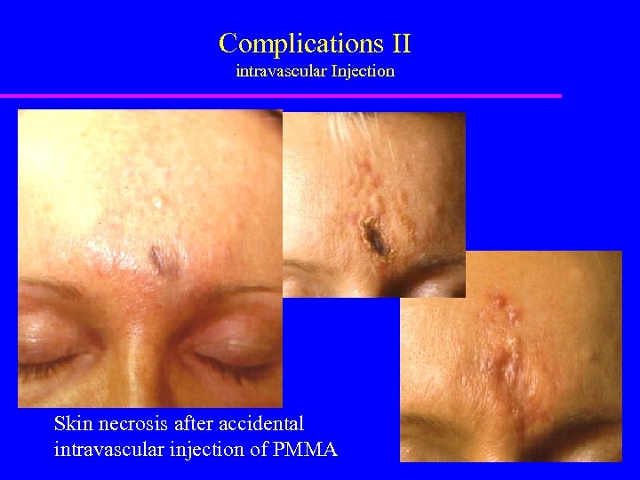 Complications II intravascular Injection Skin necrosis after accidental intravascular injection of PMMA 