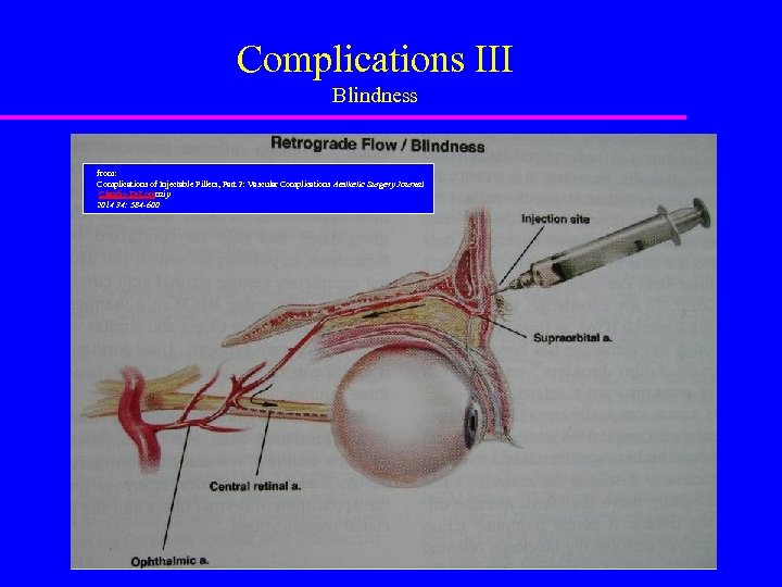 Complications III Blindness from: Complications of Injectable Fillers, Part 2: Vascular Complications Aesthetic Surgery
