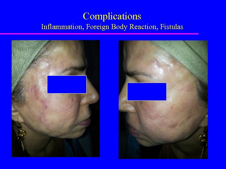 Complications Inflammation, Foreign Body Reaction, Fistulas 