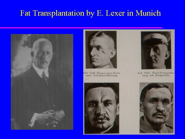 Fat Transplantation by E. Lexer in Munich 
