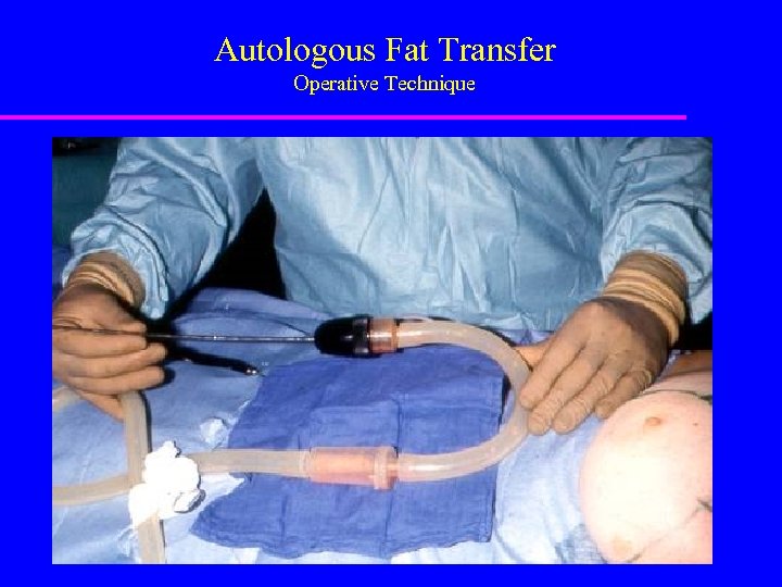 Autologous Fat Transfer Operative Technique 