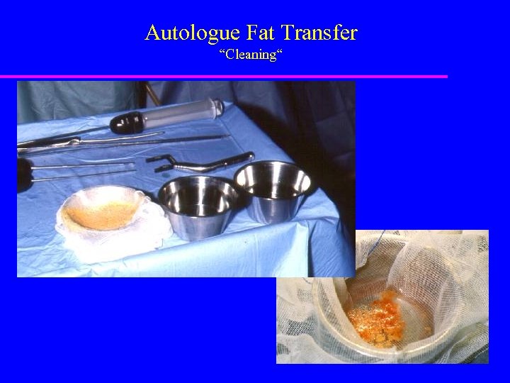 Autologue Fat Transfer “Cleaning“ 