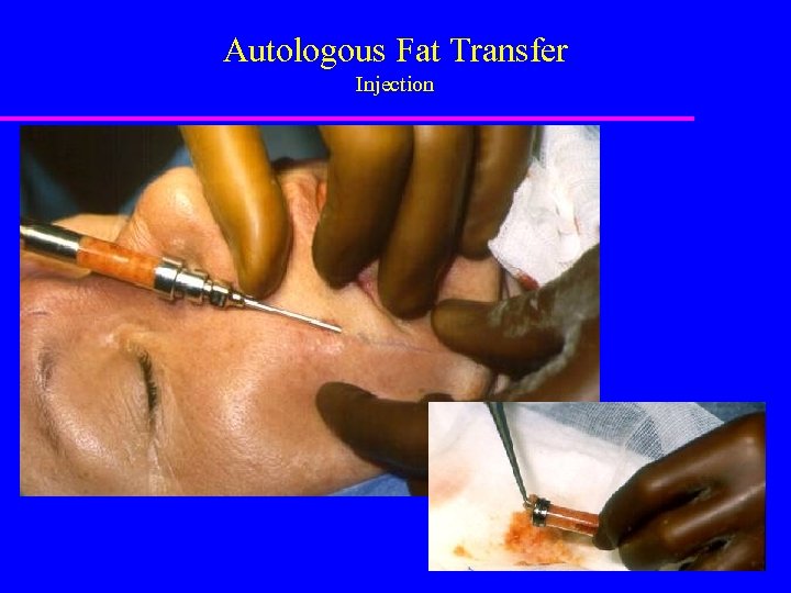 Autologous Fat Transfer Injection 