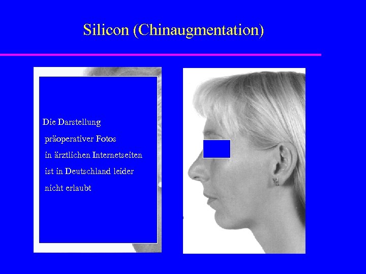 Silicon (Chinaugmentation) Die Darstellung präoperativer Fotos in ärztlichen Internetseiten ist in Deutschland leider nicht
