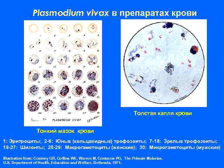 Plasmodium vivax в препаратах крови Толстая капля крови Тонкий мазок крови 1: Эритроциты; 2