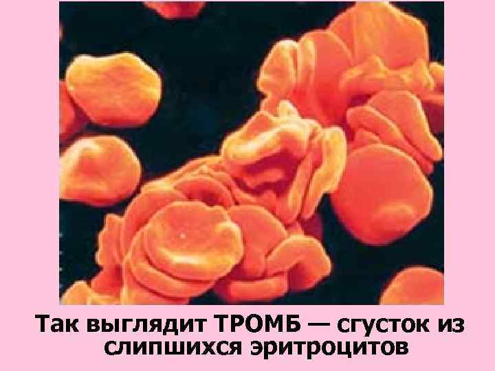 Так выглядит ТРОМБ — сгусток из слипшихся эритроцитов 