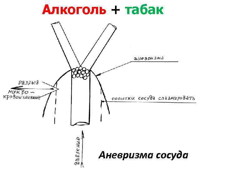 Алкоголь + табак Аневризма сосуда 