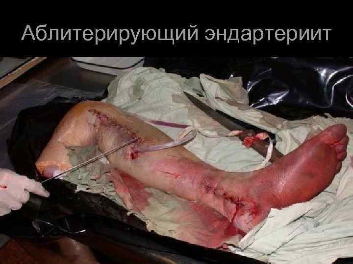 Аблитерирующий эндартериит 