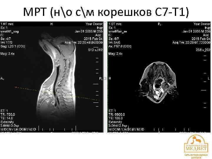 МРТ (но см корешков С 7 -Т 1) 