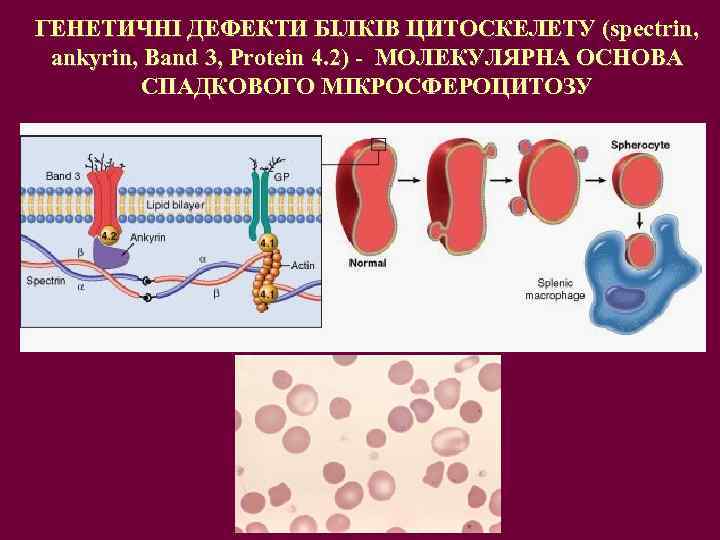 ГЕНЕТИЧНІ ДЕФЕКТИ БІЛКІВ ЦИТОСКЕЛЕТУ (spectrin, ankyrin, Band 3, Protein 4. 2) - МОЛЕКУЛЯРНА ОСНОВА