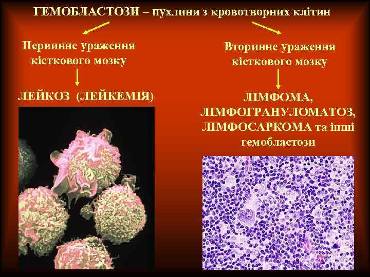 ГЕМОБЛАСТОЗИ – пухлини з кровотворних клітин Первинне ураження кісткового мозку ЛЕЙКОЗ (ЛЕЙКЕМІЯ) Вторинне ураження