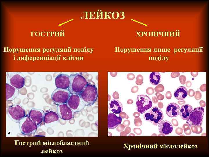 ЛЕЙКОЗ ГОСТРИЙ ХРОНІЧНИЙ Порушення регуляції поділу і диференціації клітин Порушення лише регуляції поділу Гострий