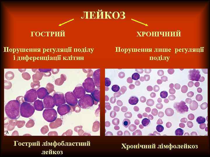 ЛЕЙКОЗ ГОСТРИЙ ХРОНІЧНИЙ Порушення регуляції поділу і диференціації клітин Порушення лише регуляції поділу Гострий