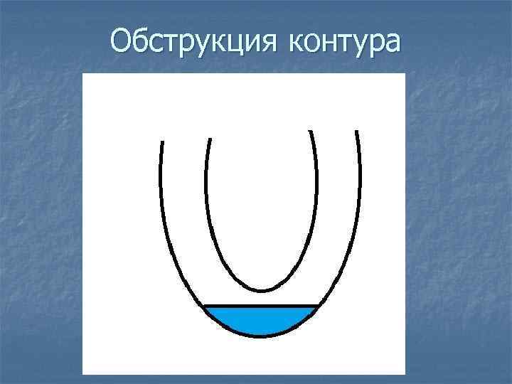 Обструкция контура 