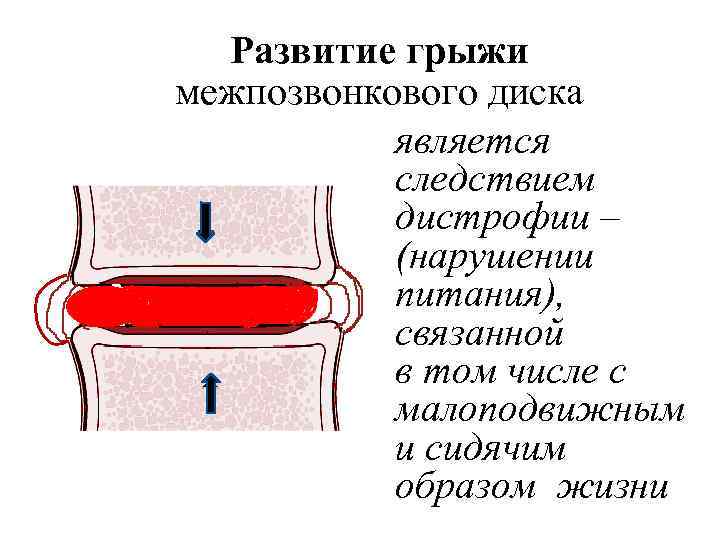 Развитие грыжи межпозвонкового диска является следствием дистрофии – (нарушении питания), связанной в том числе