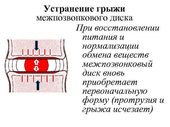 Устранение грыжи межпозвонкового диска При восстановлении питания и нормализации обмена веществ межпозвонковый диск вновь