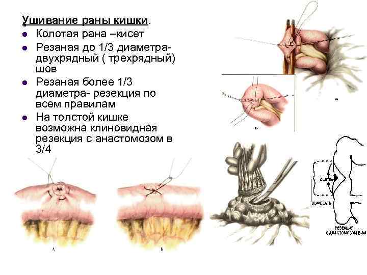 . Ушивание раны кишки. l Колотая рана –кисет l Резаная до 1/3 диаметрадвухрядный (