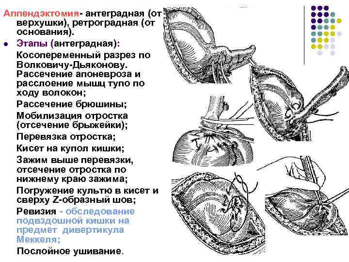 Аппендэктомия- антеградная (от верхушки), ретроградная (от основания). l Этапы (антеградная): Косопеременный разрез по Волковичу-Дьяконову.