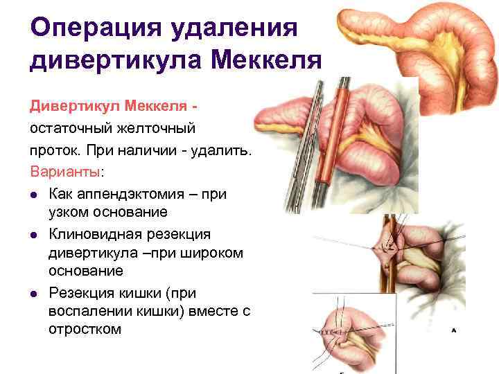 Операция удаления дивертикула Меккеля Дивертикул Меккеля остаточный желточный проток. При наличии - удалить. Варианты: