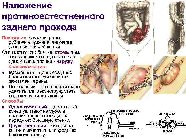 Наложение противоестественного заднего прохода Показания: опухоли, раны, рубцовые сужения, аномалии развития прямой кишки Отличается