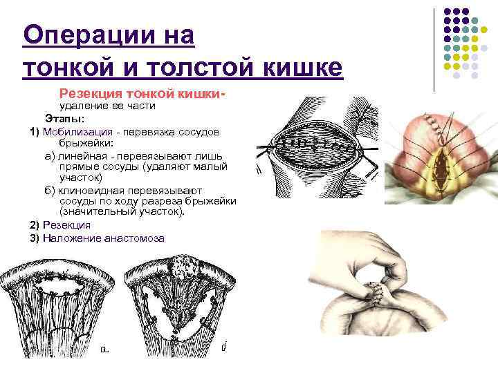 Операции на тонкой и толстой кишке Резекция тонкой кишки- удаление ее части Этапы: 1)