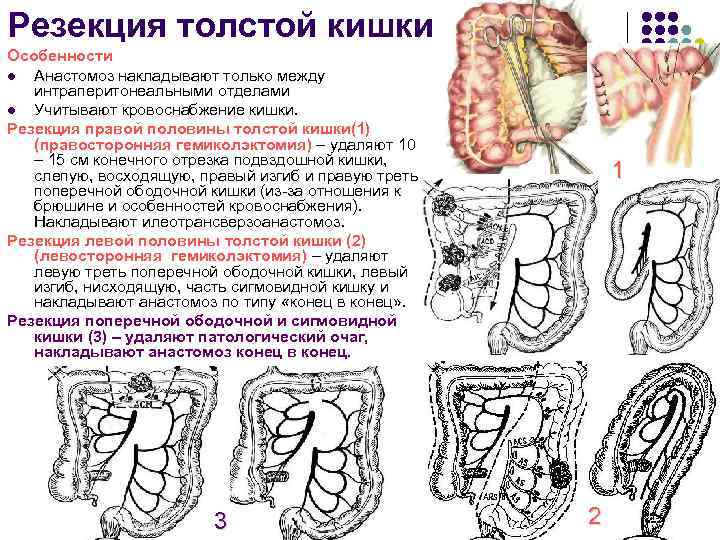 Резекция толстой кишки Особенности l Анастомоз накладывают только между интраперитонеальными отделами l Учитывают кровоснабжение