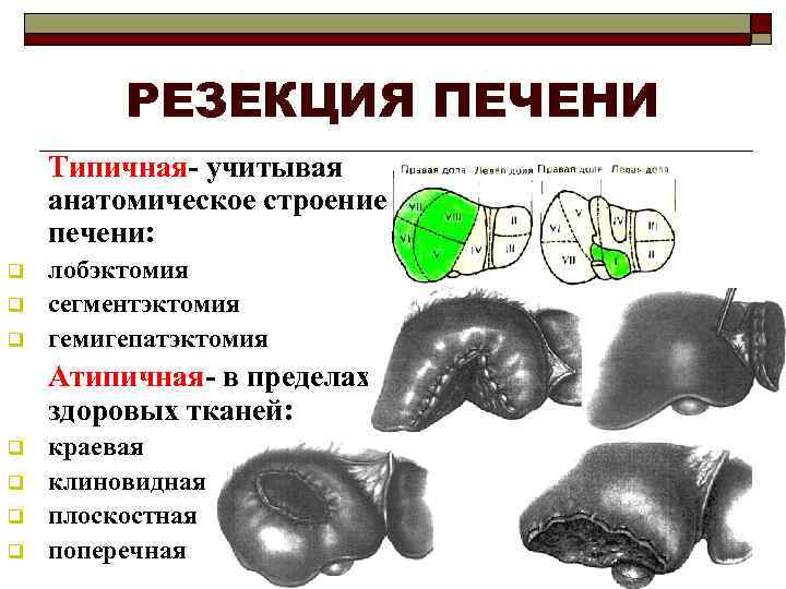 РЕЗЕКЦИЯ ПЕЧЕНИ Типичная- учитывая анатомическое строение печени: q q q лобэктомия сегментэктомия гемигепатэктомия Атипичная-