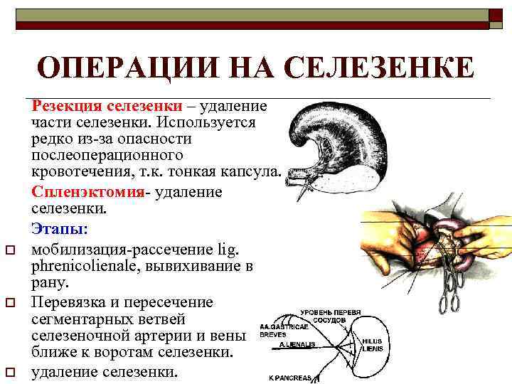 ОПЕРАЦИИ НА СЕЛЕЗЕНКЕ o o o Резекция селезенки – удаление части селезенки. Используется редко