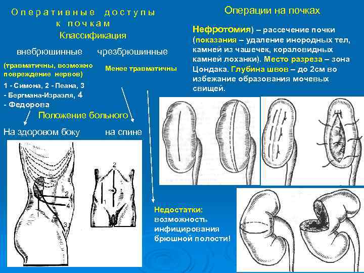 Оперативные доступы к почкам Классификация внебрюшинные (травматичны, возможно повреждение нервов) чрезбрюшинные Менее травматичны 1