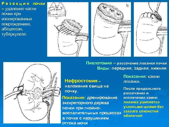 Р е з е к ц и я почки – удаление части почки при