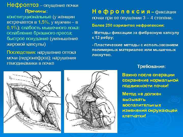 Нефроптоз – опущение почки Причины: конституциональные (у женщин встречается в 1, 5%, у мужчин