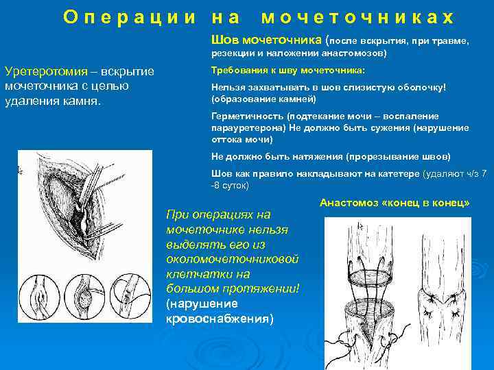 Операции на мочеточниках Шов мочеточника (после вскрытия, при травме, резекции и наложении анастомозов) Уретеротомия