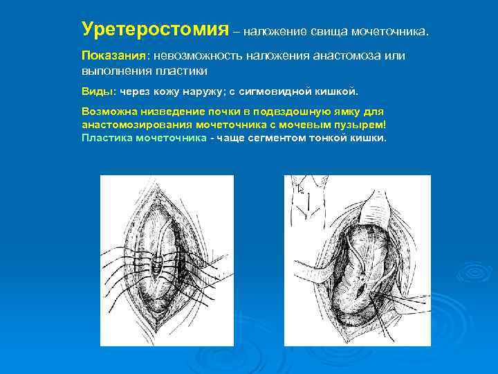 Уретеростомия – наложение свища мочеточника. Показания: невозможность наложения анастомоза или выполнения пластики Виды: через