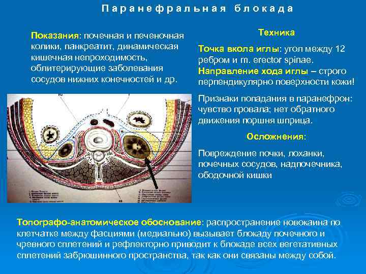 Паранефральная блокада Показания: почечная и печеночная колики, панкреатит, динамическая кишечная непроходимость, облитерирующие заболевания сосудов